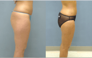 Liposuction #004, before and after photo, view 2
