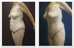 Body Lift #001, before and after photo, view 3