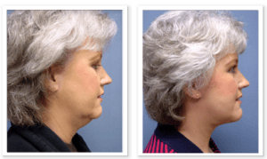 Face Lift #002, before and after photo, view 2