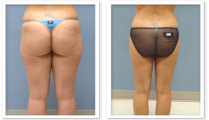 Liposuction #004, before and after photo, view 3