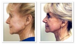 Face Lift #003, before and after photo, view 2