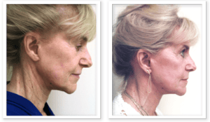 Face Lift #003, before and after photo, view 3