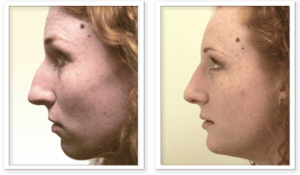 Nose Reshaping #002, before and after photo