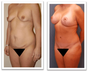 Tummy Tuck #005, before and after photo, view 2