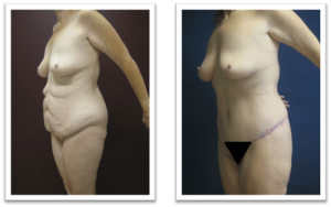 Tummy Tuck #006, before and after photo, view 2