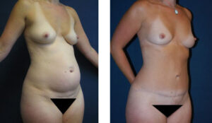 Tummy Tuck #008, before and after photo, view 2
