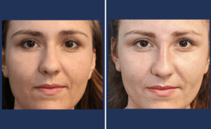 Non-Surgical Nose Reshaping #001, before and after photo