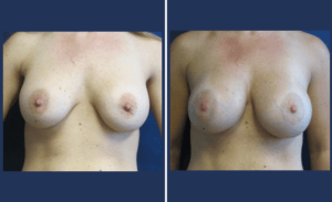 Implant Revision #001, before and after photo