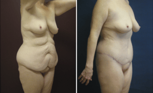 Body Lift #001, before and after photo
