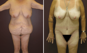 Body Lift #002, before and after photo
