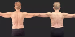 Arm Lift #001, before and after photo