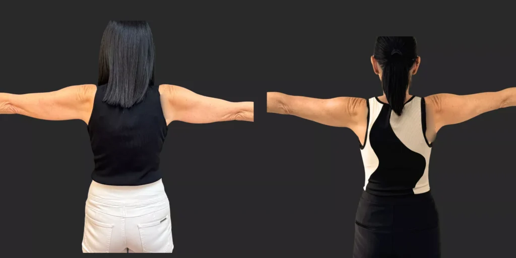 Arm Lift #002, before and after photo