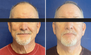 Face & Neck Lift #001, before and after photo