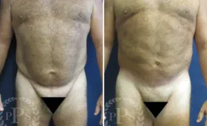 Liposuction #011, before and after photo