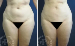 Liposuction #012, before and after photo