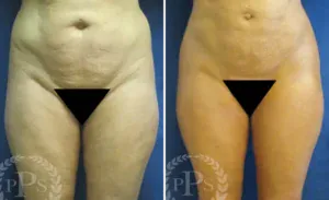 Liposuction #013, before and after photo