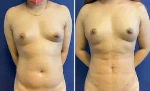 Liposuction #016, before and after photo