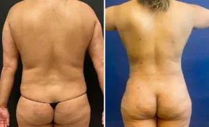 Liposuction #017, before and after photo