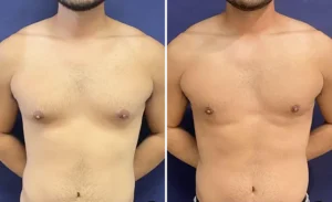Liposuction #19, before and after photo