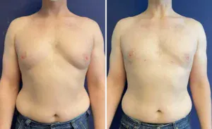 Liposuction #20, before and after photo