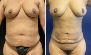 Liposuction #21, before and after photo