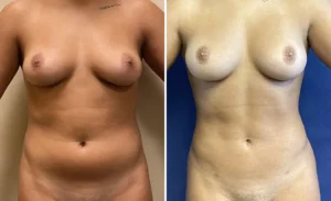 Liposuction #23, before and after photo