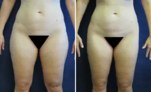 Liposuction #003, before and after photo