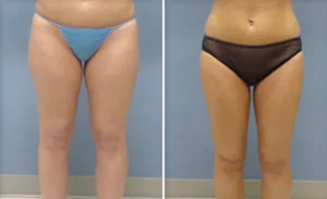Liposuction #004, before and after photo