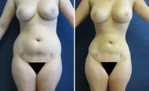 Liposuction #005, before and after photo