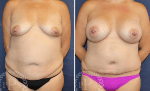 Mommy Makeover #001, before and after photo