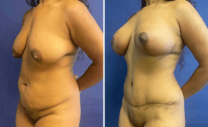 Mommy Makeover #002, before and after photo