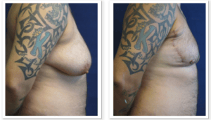 FTM Chest Masculinization Surgery #002, before and after photo, view 2