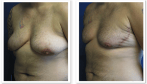 FTM Chest Masculinization Surgery #002, before and after photo, view 3