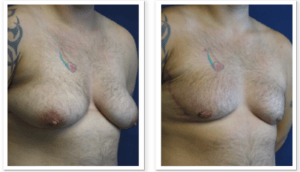 FTM Chest Masculinization Surgery #002, before and after photo, view 4