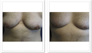 FTM Chest Masculinization Surgery #002, before and after photo, view 5