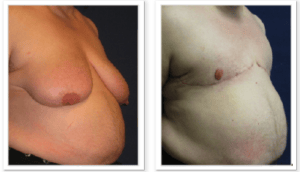 FTM Chest Masculinization Surgery #001, before and after photo, view 2