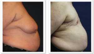 FTM Chest Masculinization Surgery #001, before and after photo, view 3
