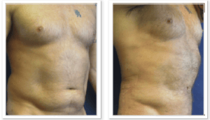 Liposuction #001, before and after photo, view 2