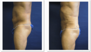 Liposuction #001, before and after photo, view 4