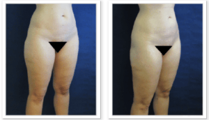 Liposuction #003, before and after photo, view 2