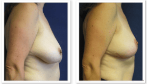Breast Lift #004, before and after photo, view 2