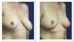 Breast Lift #004, before and after photo, view 3