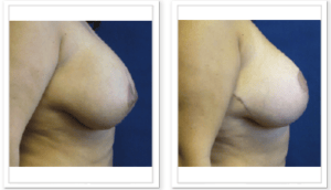 Breast Lift  #001, before and after photo, view 2
