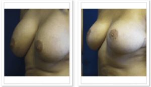 Breast Lift  #001, before and after photo, view 3