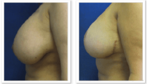 Breast Lift  #001, before and after photo, view 4