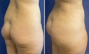 S.A.F.E. Liposuction with BBL #001, before and after photo