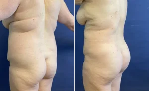 S.A.F.E. Liposuction with BBL #002, before and after photo