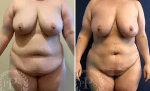 S.A.F.E. Liposculpture #001, before and after photo