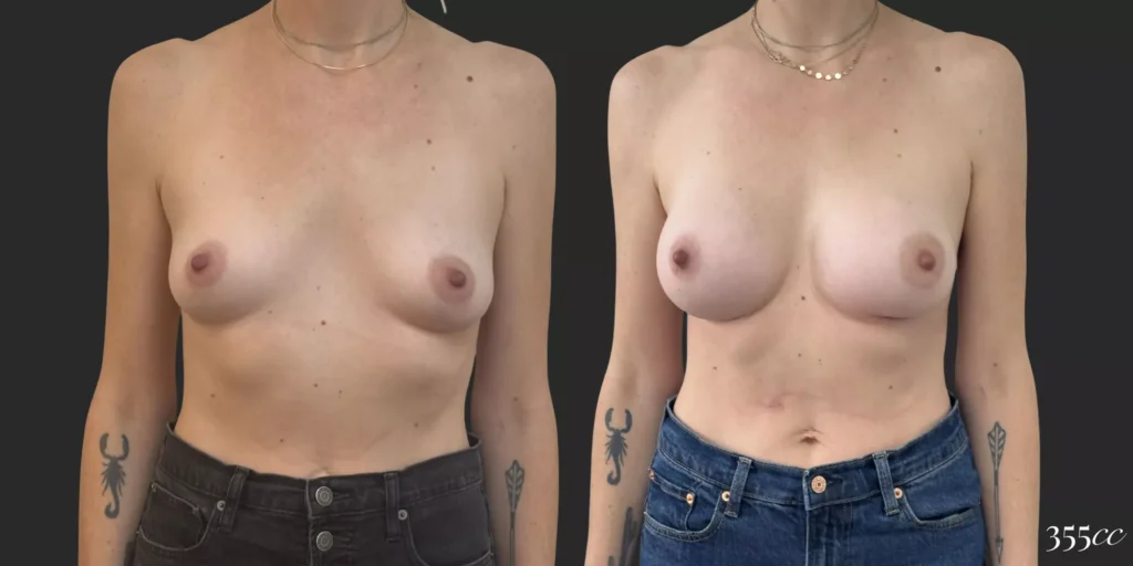 Breast Augmentation #64, before and after photo