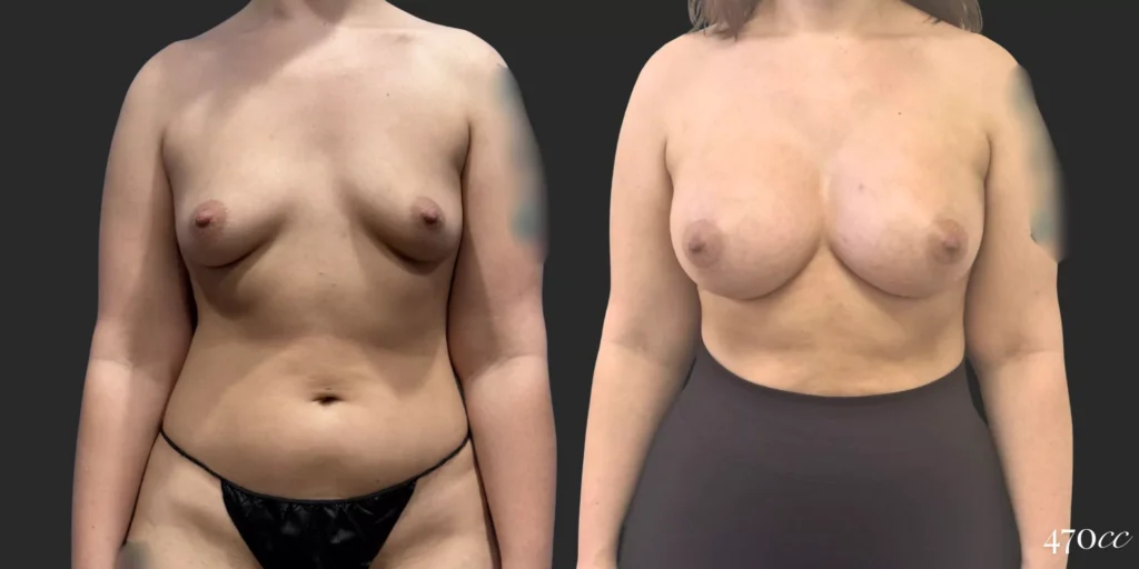Breast Augmentation #65, before and after photo